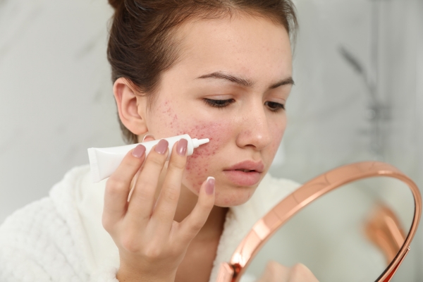 Eine junge Frau behandelt ihren Ausschlag im Gesicht mit einer Creme mit Metronidazol.