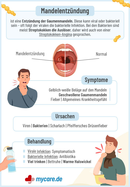 Infografik Mandelentzündung: Symptome, Ursachen und Behandlung