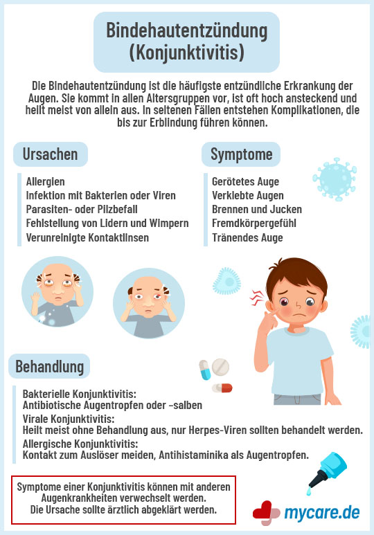 Infografik Bindehautentzündung: Ursachen, Symptome, Behandlung