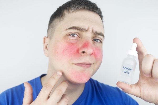 Ein Mann mit deutlichen Hautrötungen im Gesicht verwendet ein Serum mit Azelainsäure dagegen.