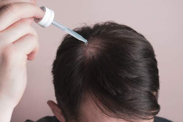 Ein Mann mit Haarausfall benutzt Minoxidil um dichteres Haar zu bekommen. Ein Mann mit Haarausfall benutzt Minoxidil um dichteres Haar zu bekommen.