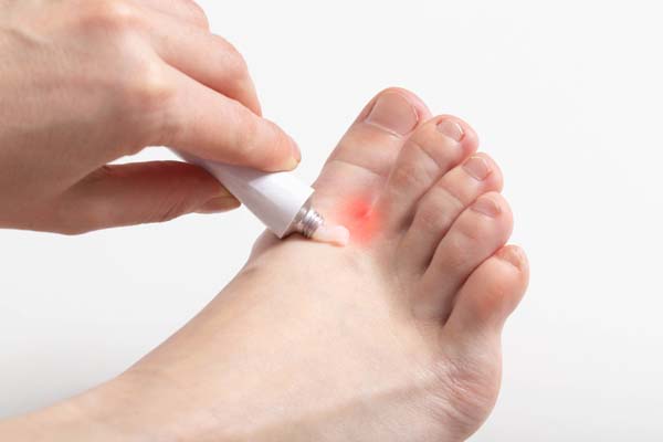Eine Pilzinfektionen am Fuß wird mit einer Creme behandelt.