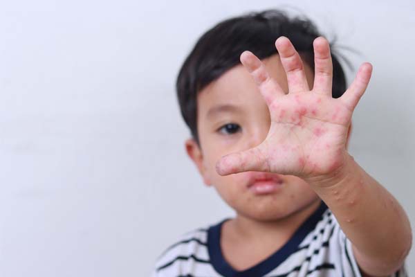 Kind mit Hautausschlag an der Hand