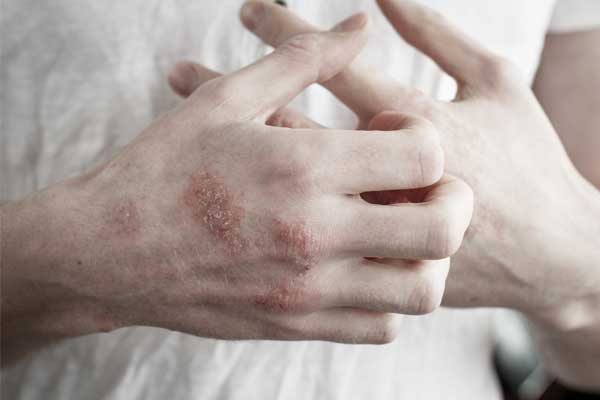 Was braucht die Haut bei Neurodermitis?
