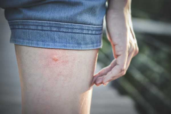 Ein Bein mit einem Mückenstich.