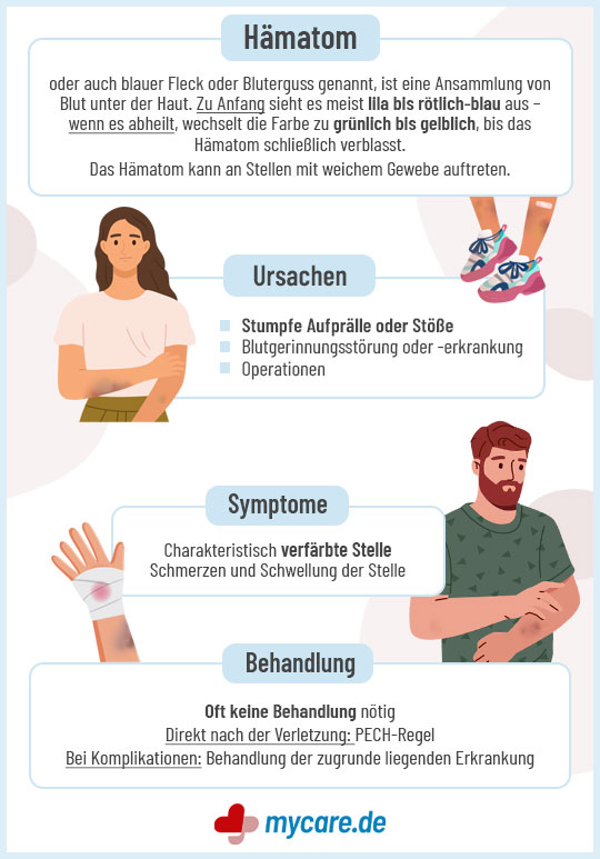 Infografik Hämatom (Bluterguss): Ursachen, Symptome und Behandlung von blauen Flecken.