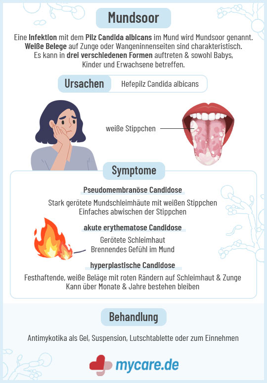 Infografik Mundsoor: Ursachen, Symptome & Behandlung