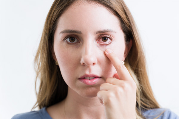 Eine Frau zeigt ihr an einer Bindehautentzündung erkranktes Auge.