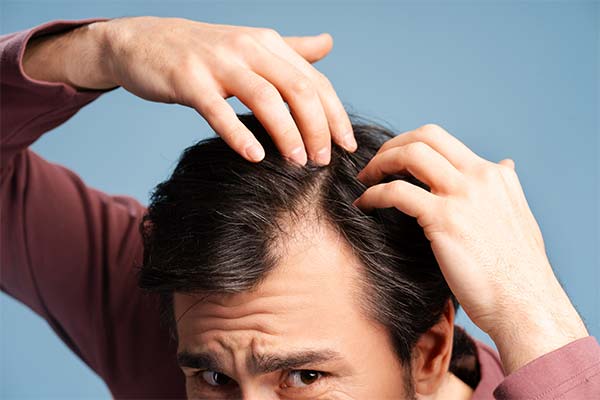 Ein Mann prüft besorgt seinen Haaransatz und die Kopfhaut als Anzeichen für beginnenden Haarausfall bei Männern. Ein Mann prüft besorgt seinen Haaransatz und die Kopfhaut als Anzeichen für beginnenden Haarausfall bei Männern.