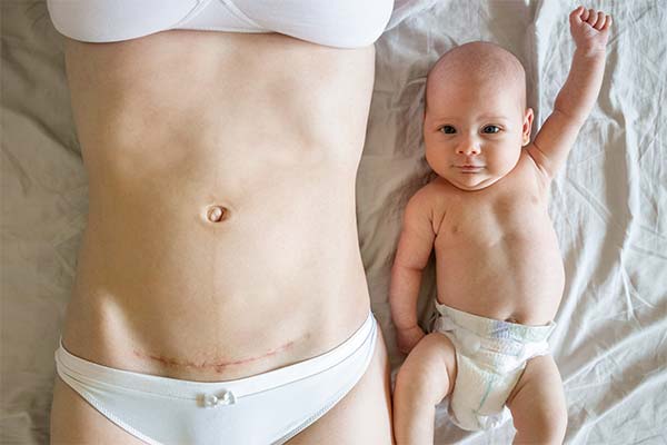 Draufsicht auf den Bauch einer Mutter mit einer frischen Kaiserschnittnarbe neben einem neugeborenen Baby in Windeln auf einem Bett. Draufsicht auf den Bauch einer Mutter mit einer frischen Kaiserschnittnarbe neben einem neugeborenen Baby in Windeln auf einem Bett.